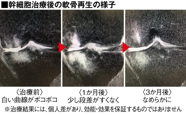 関節の再生医療 リソークリニック